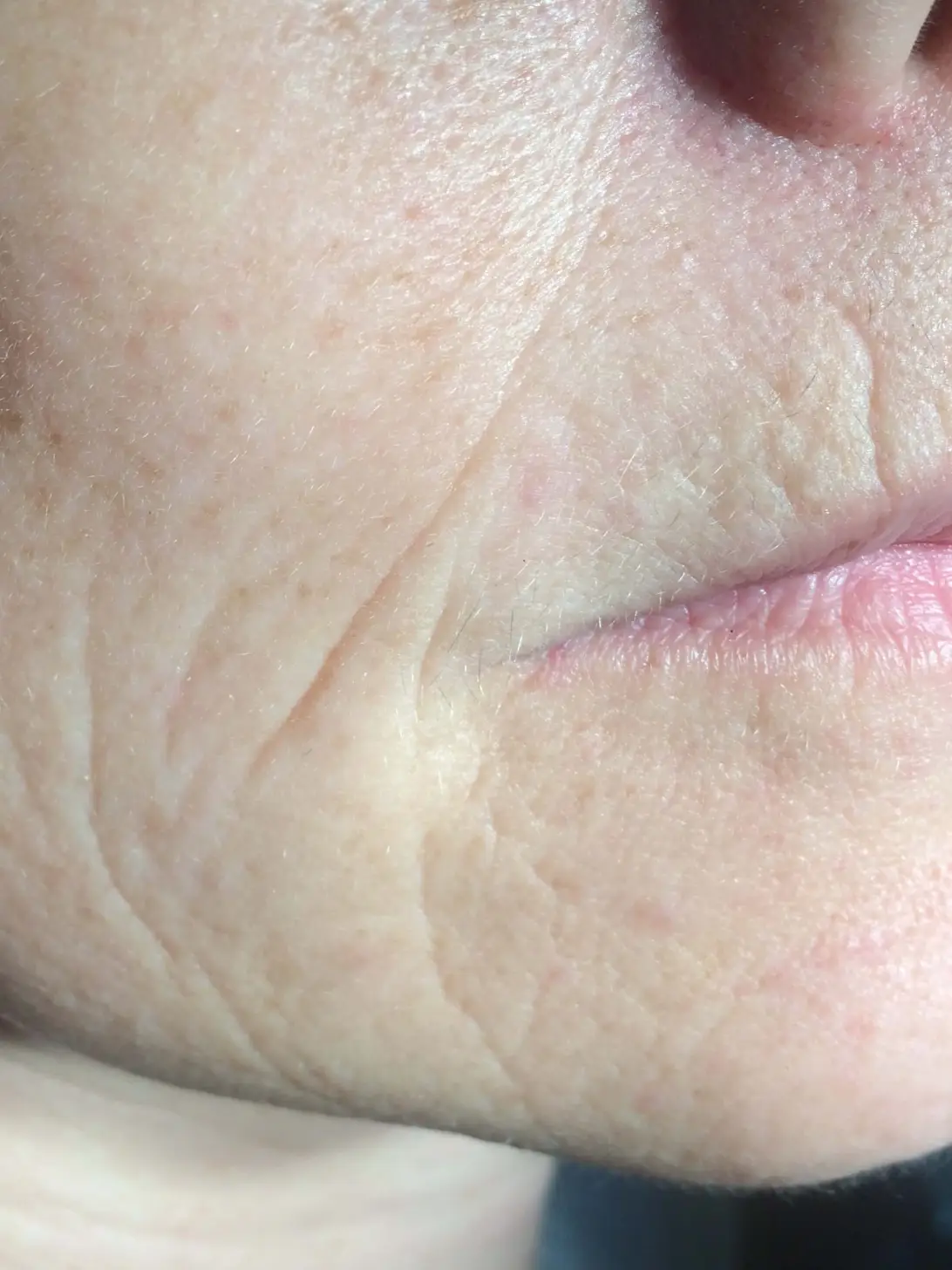 Before: Botox